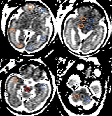 Sex differences in normal fetal regional brain apparent diffusion coefficient changes assessed by in utero DWI